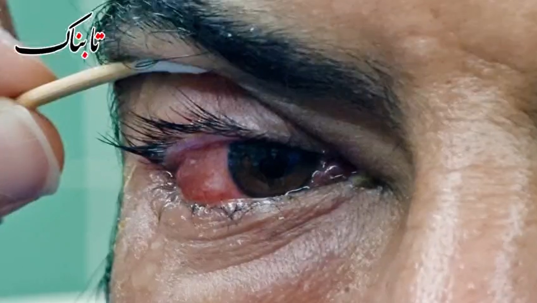 نجات چشم بیمار با مهارت بی‌نظیر تیم پزشکی اهواز + فیلم